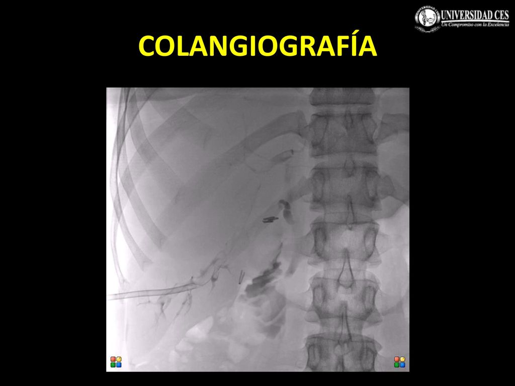 COLANGIOGRAFÍA Radiología intervencionista decide realizar colangiografía transparietohepática para tratar de extraer el parasito.
