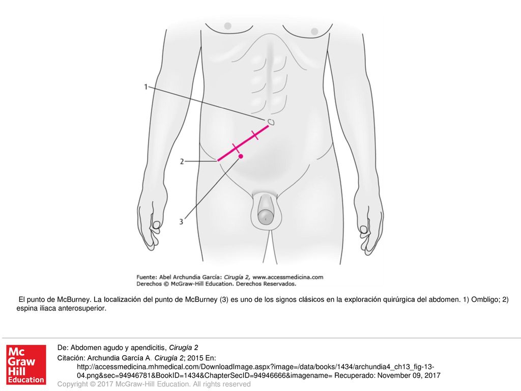 El punto de McBurney. La localización del punto de McBurney (3) es uno de los signos clásicos en la exploración quirúrgica del abdomen. 1) Ombligo; 2) espina iliaca anterosuperior.