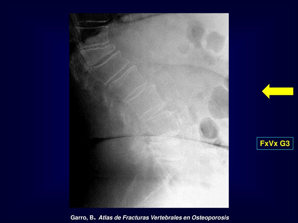 FxVx G3 Garro, B. Atlas de Fracturas Vertebrales en Osteoporosis
