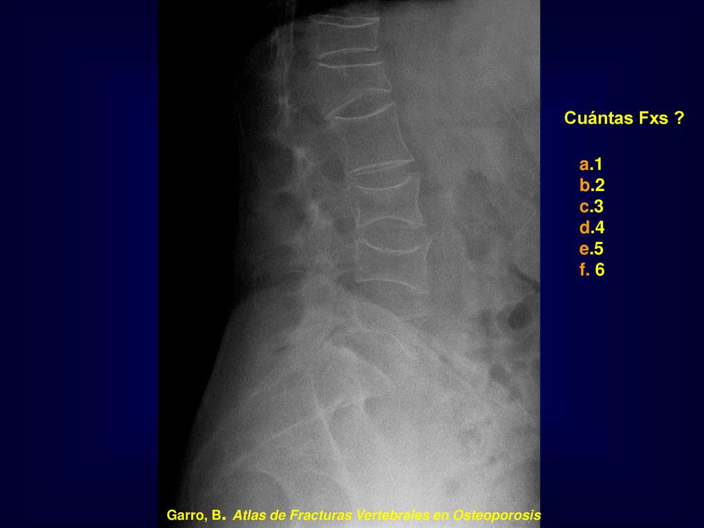 Cuántas Fxs a.1 b.2 c.3 d.4 e.5 f. 6 Garro, B. Atlas de Fracturas Vertebrales en Osteoporosis