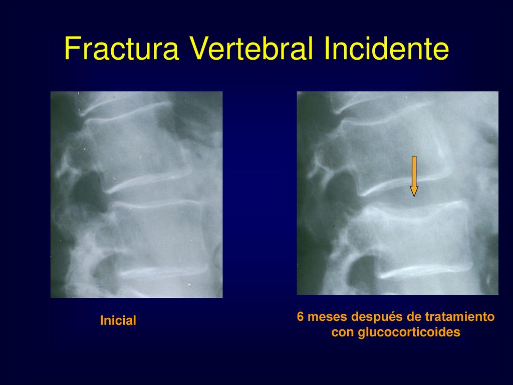 6 meses después de tratamiento con glucocorticoides
