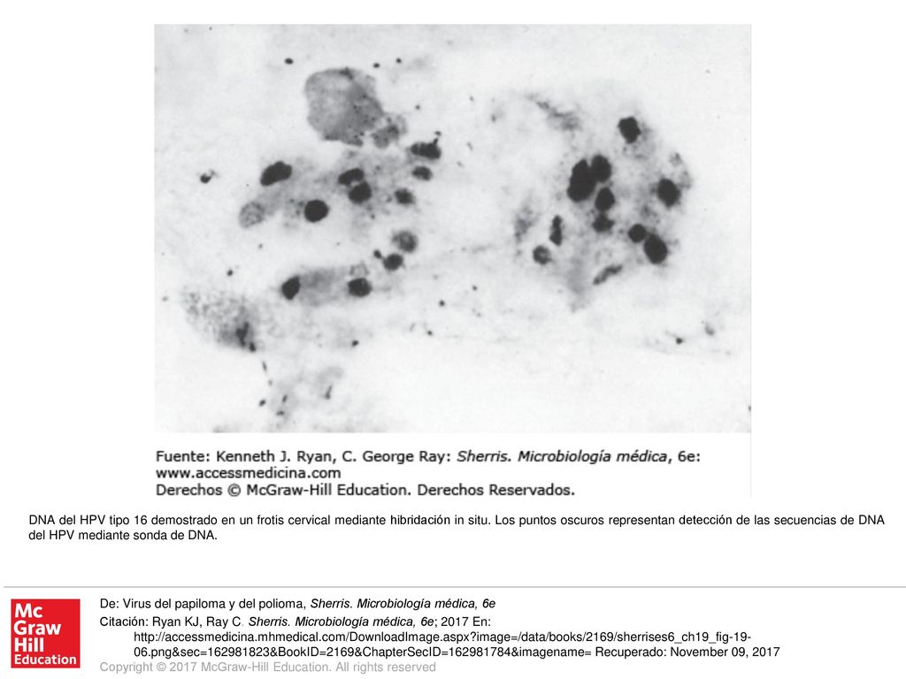 DNA del HPV tipo 16 demostrado en un frotis cervical mediante hibridación in situ. Los puntos oscuros representan detección de las secuencias de DNA del HPV mediante sonda de DNA.
