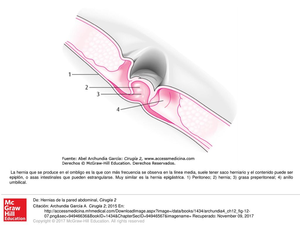 La hernia que se produce en el ombligo es la que con más frecuencia se observa en la línea media, suele tener saco herniario y el contenido puede ser epiplón, o asas intestinales que pueden estrangularse. Muy similar es la hernia epigástrica. 1) Peritoneo; 2) hernia; 3) grasa preperitoneal; 4) anillo umbilical.