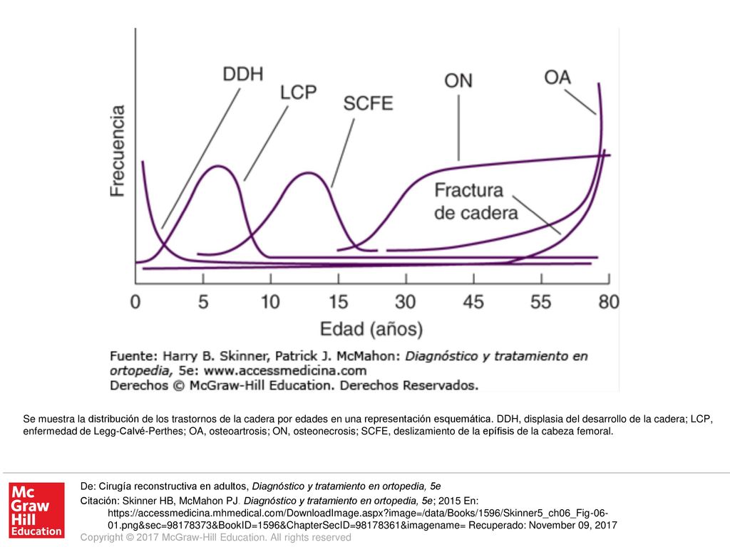 Se muestra la distribución de los trastornos de la cadera por edades en una representación esquemática. DDH, displasia del desarrollo de la cadera; LCP, enfermedad de Legg-Calvé-Perthes; OA, osteoartrosis; ON, osteonecrosis; SCFE, deslizamiento de la epífisis de la cabeza femoral.