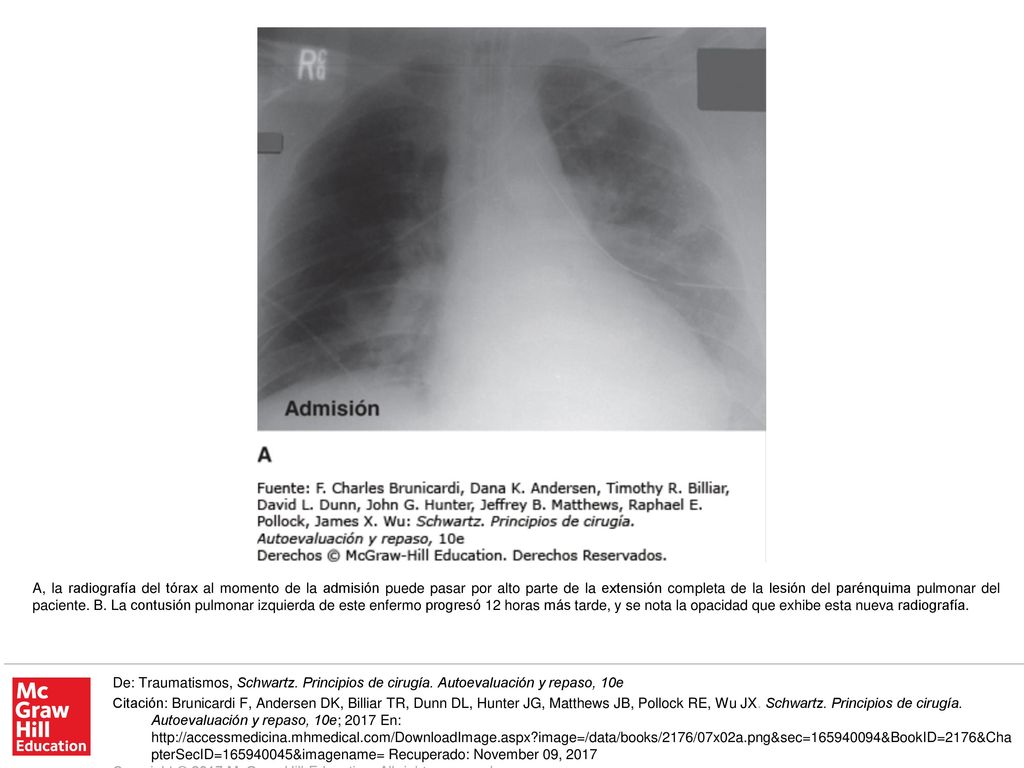 A, la radiografía del tórax al momento de la admisión puede pasar por alto parte de la extensión completa de la lesión del parénquima pulmonar del paciente. B. La contusión pulmonar izquierda de este enfermo progresó 12 horas más tarde, y se nota la opacidad que exhibe esta nueva radiografía.