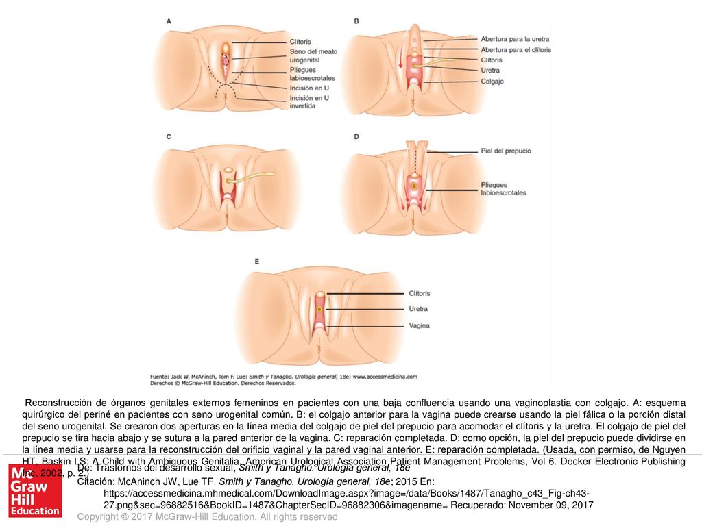Reconstrucción de órganos genitales externos femeninos en pacientes con una baja confluencia usando una vaginoplastia con colgajo. A: esquema quirúrgico del periné en pacientes con seno urogenital común. B: el colgajo anterior para la vagina puede crearse usando la piel fálica o la porción distal del seno urogenital. Se crearon dos aperturas en la línea media del colgajo de piel del prepucio para acomodar el clítoris y la uretra. El colgajo de piel del prepucio se tira hacia abajo y se sutura a la pared anterior de la vagina. C: reparación completada. D: como opción, la piel del prepucio puede dividirse en la línea media y usarse para la reconstrucción del orificio vaginal y la pared vaginal anterior. E: reparación completada. (Usada, con permiso, de Nguyen HT, Baskin LS: A Child with Ambiguous Genitalia. American Urological Association Patient Management Problems, Vol 6. Decker Electronic Publishing Inc, 2002, p. 2.)