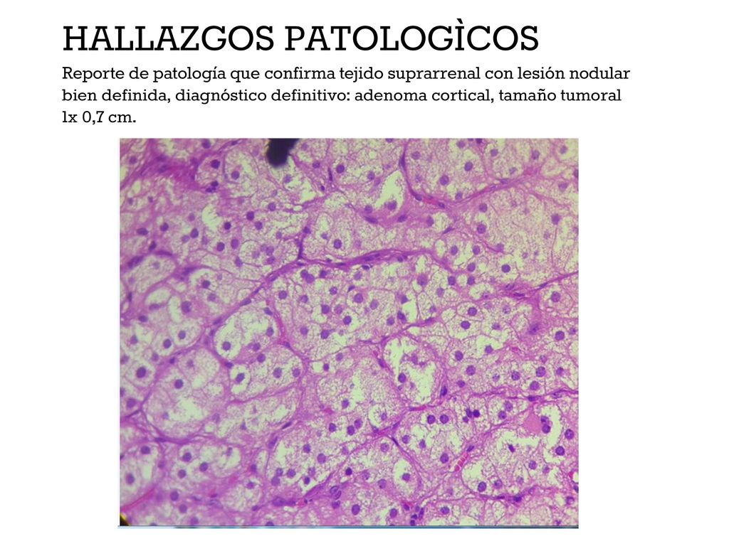 HALLAZGOS PATOLOGÌCOS Reporte de patología que confirma tejido suprarrenal con lesión nodular bien definida, diagnóstico definitivo: adenoma cortical, tamaño tumoral 1x 0,7 cm.