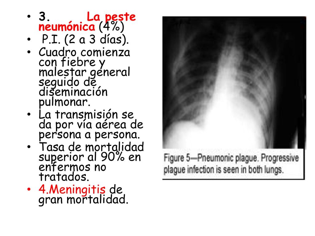 3. La peste neumónica (4%) P.I. (2 a 3 días). Cuadro comienza con fiebre y malestar general seguido de diseminación pulmonar.