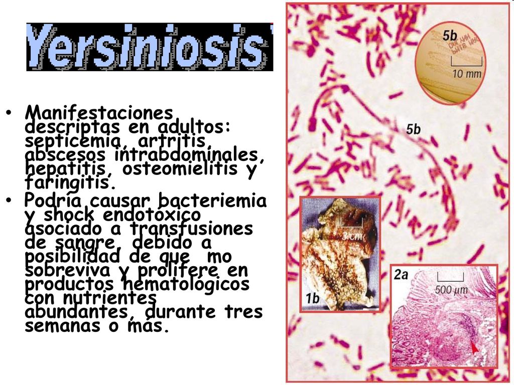 Manifestaciones descriptas en adultos: septicemia, artritis, abscesos intrabdominales, hepatitis, osteomielitis y faringitis.