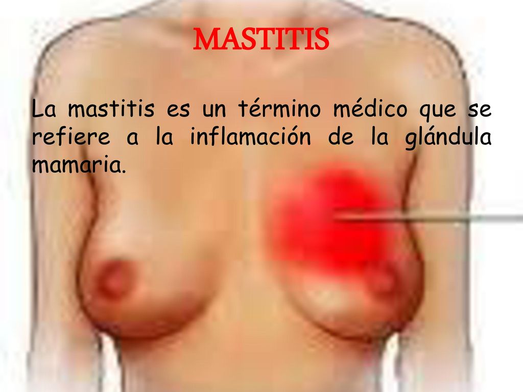 MASTITIS La mastitis es un término médico que se refiere a la inflamación de la glándula mamaria.