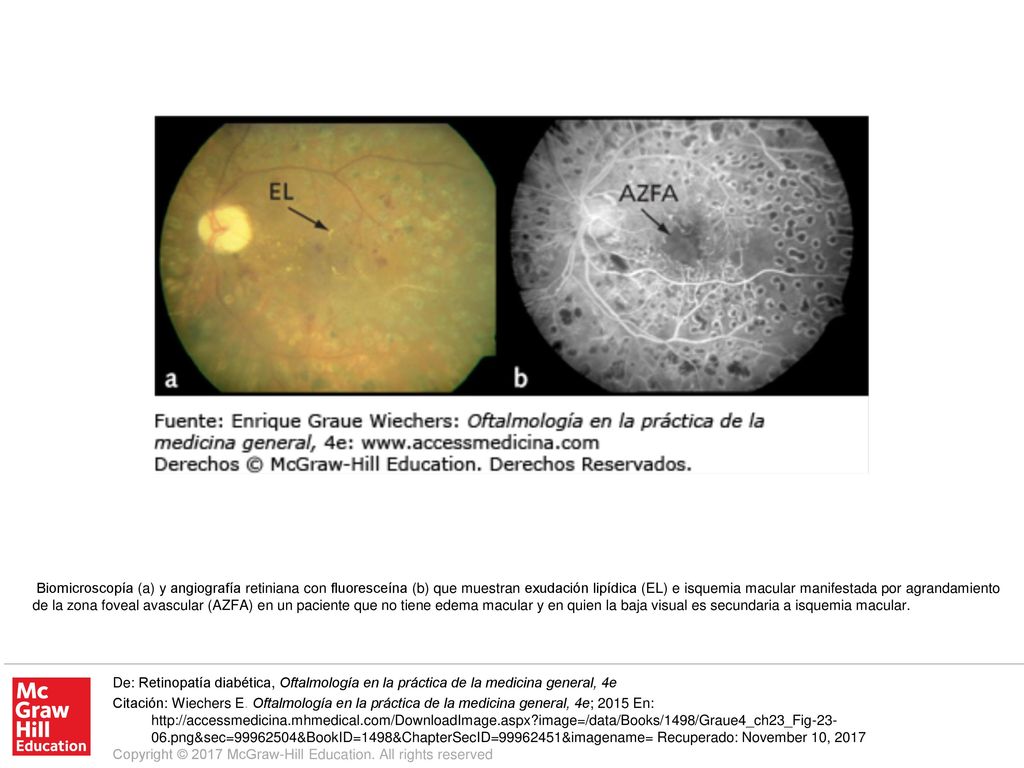 Biomicroscopía (a) y angiografía retiniana con fluoresceína (b) que muestran exudación lipídica (EL) e isquemia macular manifestada por agrandamiento de la zona foveal avascular (AZFA) en un paciente que no tiene edema macular y en quien la baja visual es secundaria a isquemia macular.