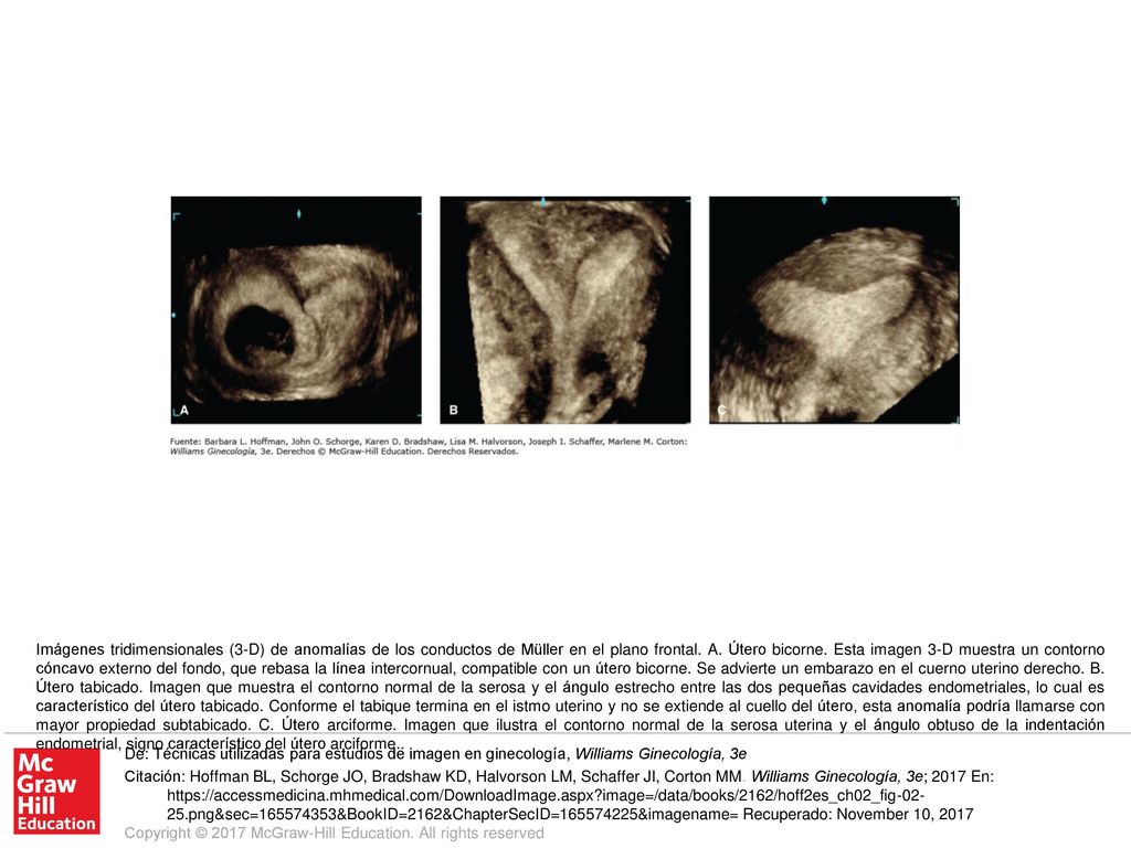 Imágenes tridimensionales (3-D) de anomalías de los conductos de Müller en el plano frontal. A. Útero bicorne. Esta imagen 3-D muestra un contorno cóncavo externo del fondo, que rebasa la línea intercornual, compatible con un útero bicorne. Se advierte un embarazo en el cuerno uterino derecho. B. Útero tabicado. Imagen que muestra el contorno normal de la serosa y el ángulo estrecho entre las dos pequeñas cavidades endometriales, lo cual es característico del útero tabicado. Conforme el tabique termina en el istmo uterino y no se extiende al cuello del útero, esta anomalía podría llamarse con mayor propiedad subtabicado. C. Útero arciforme. Imagen que ilustra el contorno normal de la serosa uterina y el ángulo obtuso de la indentación endometrial, signo característico del útero arciforme..