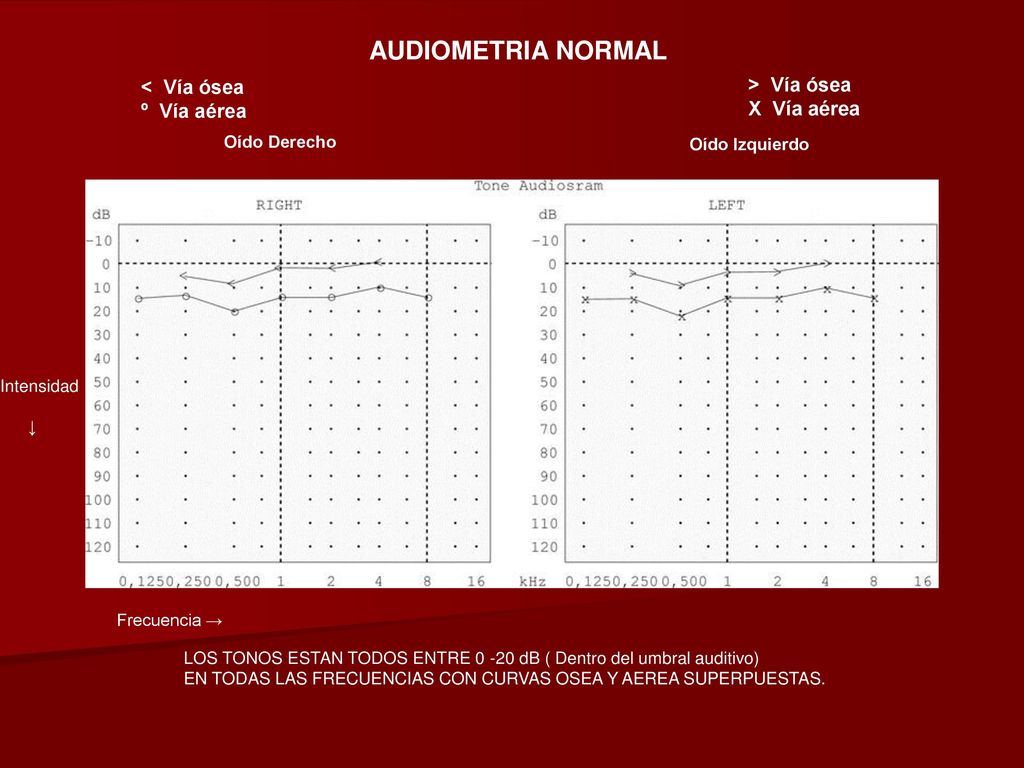 AUDIOMETRIA NORMAL < Vía ósea > Vía ósea º Vía aérea X Vía aérea