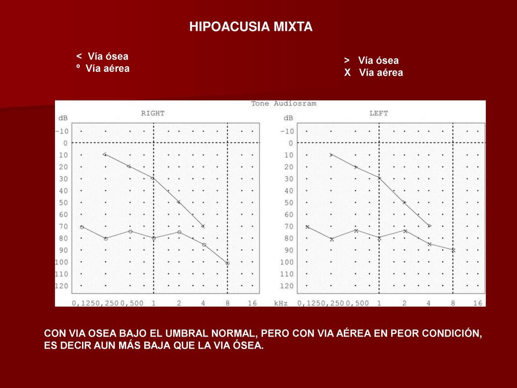 HIPOACUSIA MIXTA < Vía ósea > Vía ósea º Vía aérea X Vía aérea