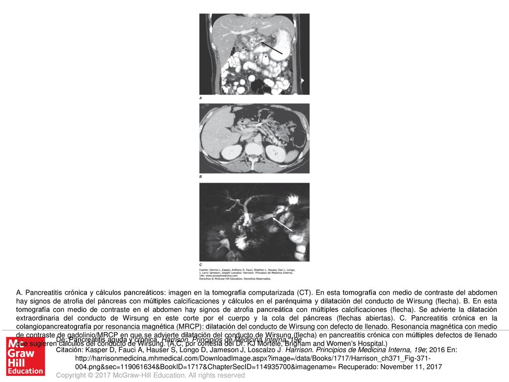 A. Pancreatitis crónica y cálculos pancreáticos: imagen en la tomografía computarizada (CT). En esta tomografía con medio de contraste del abdomen hay signos de atrofia del páncreas con múltiples calcificaciones y cálculos en el parénquima y dilatación del conducto de Wirsung (flecha). B. En esta tomografía con medio de contraste en el abdomen hay signos de atrofia pancreática con múltiples calcificaciones (flecha). Se advierte la dilatación extraordinaria del conducto de Wirsung en este corte por el cuerpo y la cola del páncreas (flechas abiertas). C. Pancreatitis crónica en la colangiopancreatografía por resonancia magnética (MRCP): dilatación del conducto de Wirsung con defecto de llenado. Resonancia magnética con medio de contraste de gadolinio/MRCP en que se advierte dilatación del conducto de Wirsung (flecha) en pancreatitis crónica con múltiples defectos de llenado que sugieren cálculos del conducto de Wirsung. (A,C, por cortesía del Dr. KJ Mortele, Brigham and Women’s Hospital.)