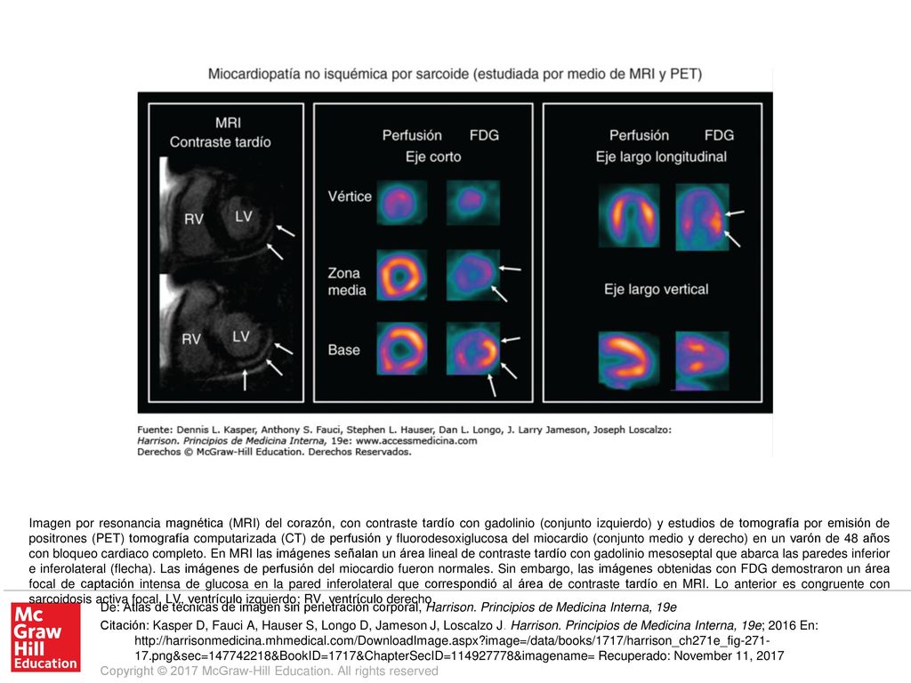 Imagen por resonancia magnética (MRI) del corazón, con contraste tardío con gadolinio (conjunto izquierdo) y estudios de tomografía por emisión de positrones (PET) tomografía computarizada (CT) de perfusión y fluorodesoxiglucosa del miocardio (conjunto medio y derecho) en un varón de 48 años con bloqueo cardiaco completo. En MRI las imágenes señalan un área lineal de contraste tardío con gadolinio mesoseptal que abarca las paredes inferior e inferolateral (flecha). Las imágenes de perfusión del miocardio fueron normales. Sin embargo, las imágenes obtenidas con FDG demostraron un área focal de captación intensa de glucosa en la pared inferolateral que correspondió al área de contraste tardío en MRI. Lo anterior es congruente con sarcoidosis activa focal. LV, ventrículo izquierdo; RV, ventrículo derecho.