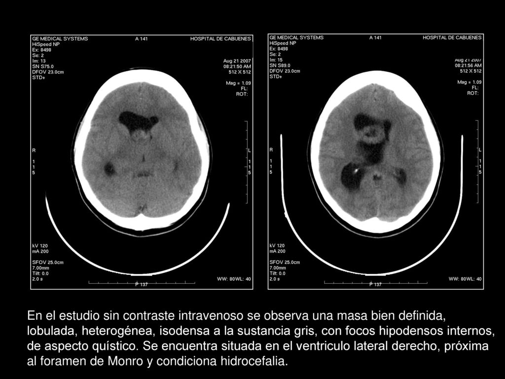 En el estudio sin contraste intravenoso se observa una masa bien definida, lobulada, heterogénea, isodensa a la sustancia gris, con focos hipodensos internos, de aspecto quístico.