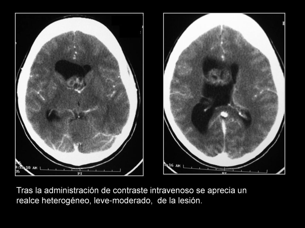 Tras la administración de contraste intravenoso se aprecia un realce heterogéneo, leve-moderado, de la lesión.