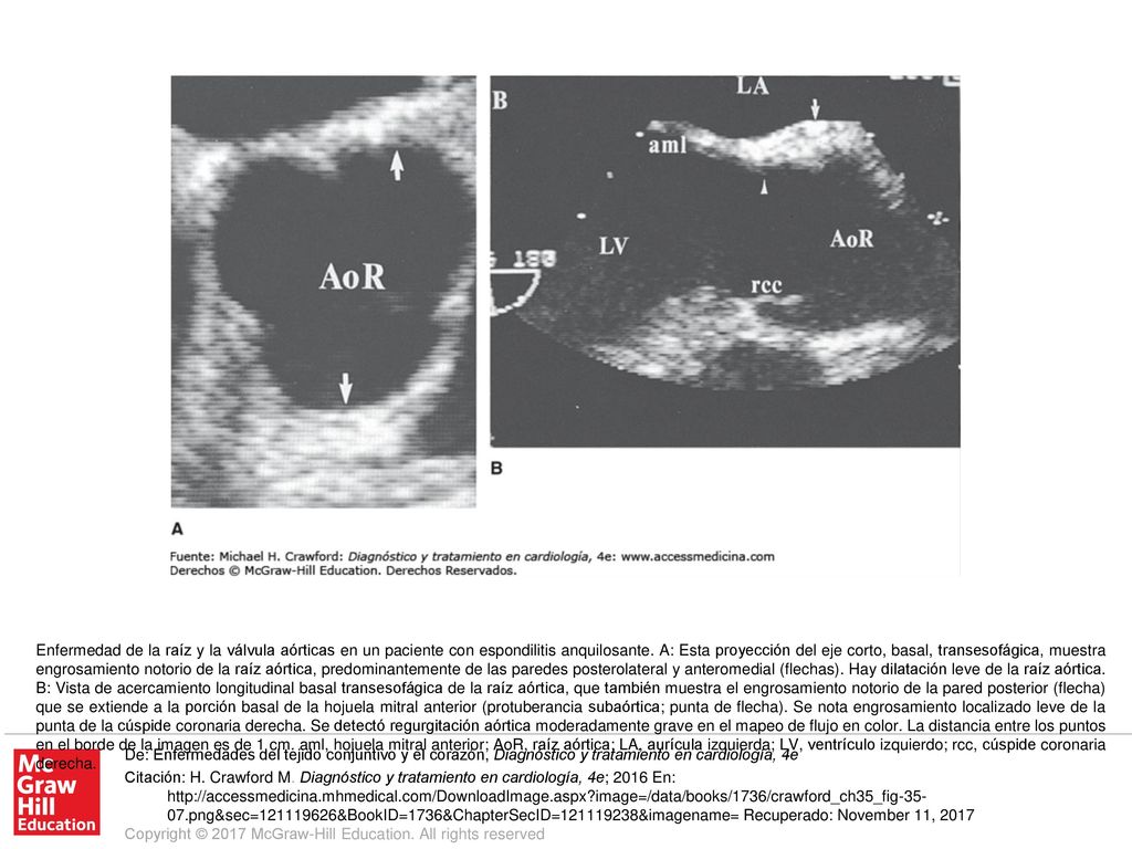 Enfermedad de la raíz y la válvula aórticas en un paciente con espondilitis anquilosante. A: Esta proyección del eje corto, basal, transesofágica, muestra engrosamiento notorio de la raíz aórtica, predominantemente de las paredes posterolateral y anteromedial (flechas). Hay dilatación leve de la raíz aórtica. B: Vista de acercamiento longitudinal basal transesofágica de la raíz aórtica, que también muestra el engrosamiento notorio de la pared posterior (flecha) que se extiende a la porción basal de la hojuela mitral anterior (protuberancia subaórtica; punta de flecha). Se nota engrosamiento localizado leve de la punta de la cúspide coronaria derecha. Se detectó regurgitación aórtica moderadamente grave en el mapeo de flujo en color. La distancia entre los puntos en el borde de la imagen es de 1 cm. aml, hojuela mitral anterior; AoR, raíz aórtica; LA, aurícula izquierda; LV, ventrículo izquierdo; rcc, cúspide coronaria derecha.