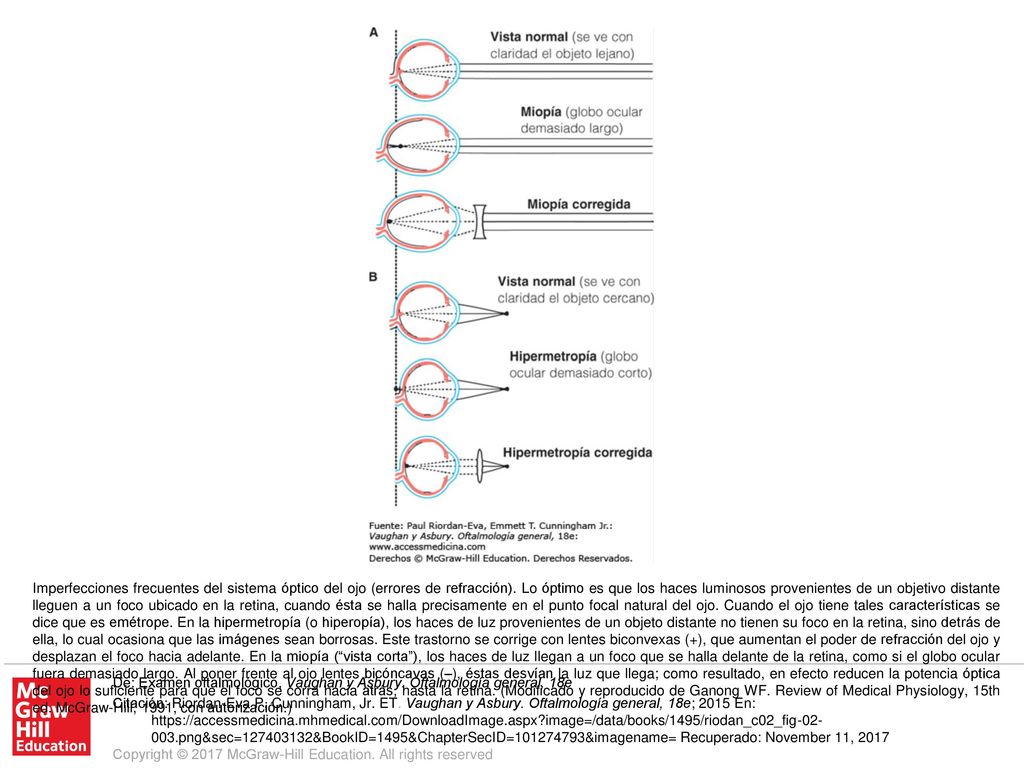 Imperfecciones frecuentes del sistema óptico del ojo (errores de refracción). Lo óptimo es que los haces luminosos provenientes de un objetivo distante lleguen a un foco ubicado en la retina, cuando ésta se halla precisamente en el punto focal natural del ojo. Cuando el ojo tiene tales características se dice que es emétrope. En la hipermetropía (o hiperopía), los haces de luz provenientes de un objeto distante no tienen su foco en la retina, sino detrás de ella, lo cual ocasiona que las imágenes sean borrosas. Este trastorno se corrige con lentes biconvexas (+), que aumentan el poder de refracción del ojo y desplazan el foco hacia adelante. En la miopía ( vista corta ), los haces de luz llegan a un foco que se halla delante de la retina, como si el globo ocular fuera demasiado largo. Al poner frente al ojo lentes bicóncavas (–), éstas desvían la luz que llega; como resultado, en efecto reducen la potencia óptica del ojo lo suficiente para que el foco se corra hacia atrás, hasta la retina. (Modificado y reproducido de Ganong WF. Review of Medical Physiology, 15th ed. McGraw-Hill, 1991, con autorización.)