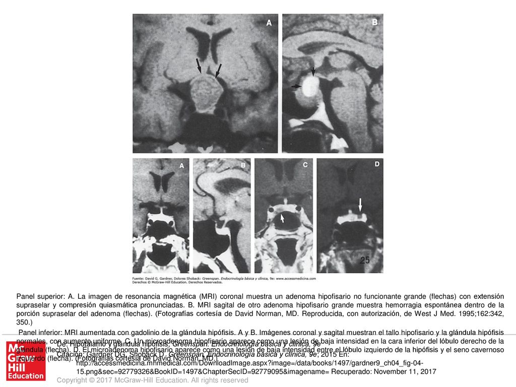 Panel inferior: MRI aumentada con gadolinio de la glándula hipófisis