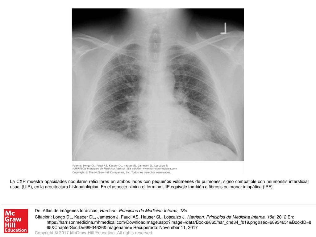 La CXR muestra opacidades nodulares reticulares en ambos lados con pequeños volúmenes de pulmones, signo compatible con neumonitis intersticial usual (UIP), en la arquitectura histopatológica. En el aspecto clínico el término UIP equivale también a fibrosis pulmonar idiopática (IPF).