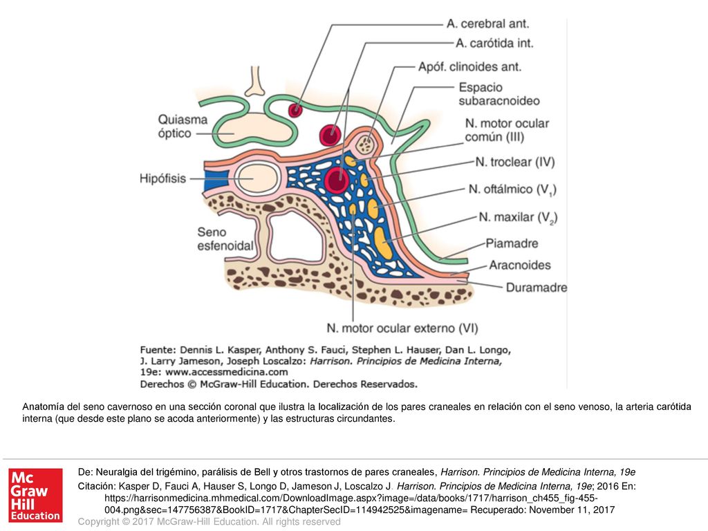 Anatomía del seno cavernoso en una sección coronal que ilustra la localización de los pares craneales en relación con el seno venoso, la arteria carótida interna (que desde este plano se acoda anteriormente) y las estructuras circundantes.