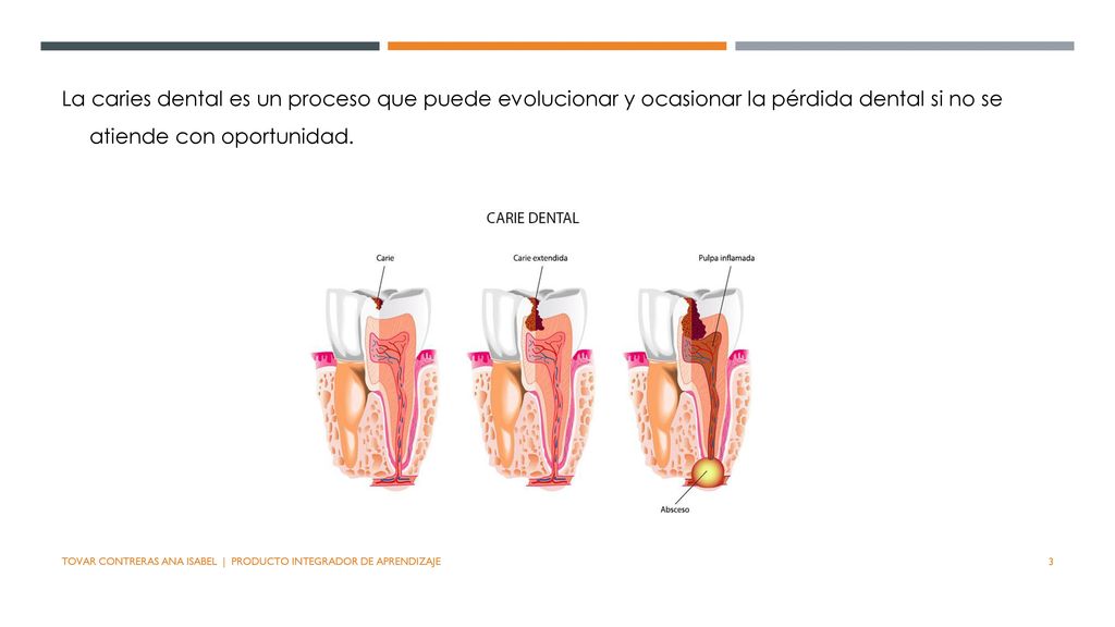 La caries dental es un proceso que puede evolucionar y ocasionar la pérdida dental si no se atiende con oportunidad.