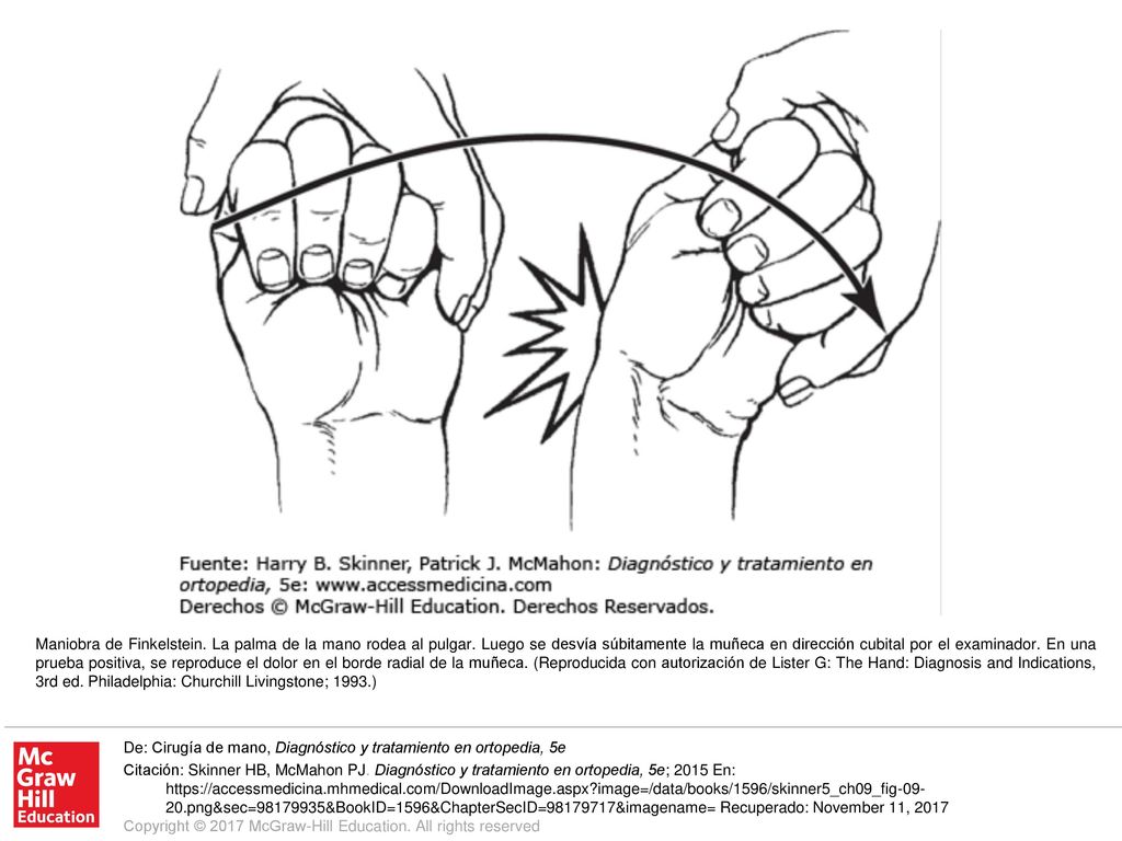 Maniobra de Finkelstein. La palma de la mano rodea al pulgar