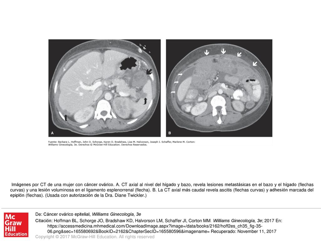 Imágenes por CT de una mujer con cáncer ovárico. A