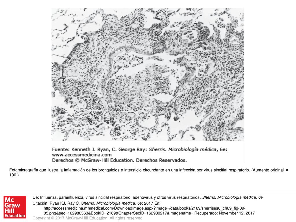 Fotomicrografía que ilustra la inflamación de los bronquiolos e intersticio circundante en una infección por virus sincitial respiratorio. (Aumento original × 100.)