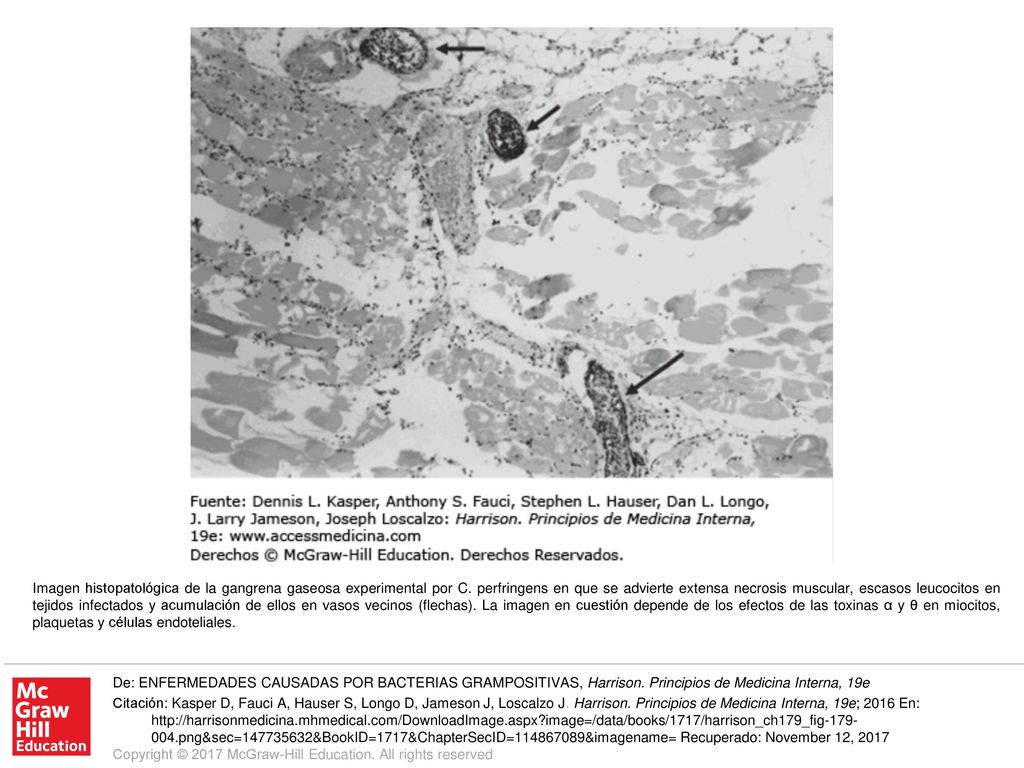 Imagen histopatológica de la gangrena gaseosa experimental por C