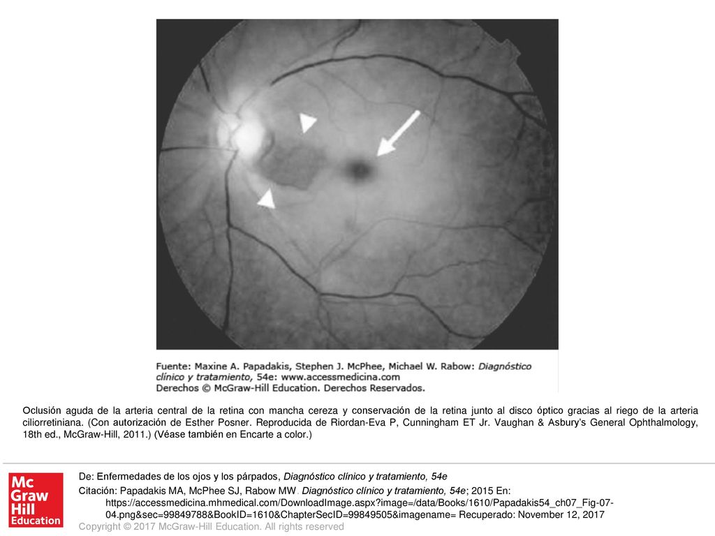 Oclusión aguda de la arteria central de la retina con mancha cereza y conservación de la retina junto al disco óptico gracias al riego de la arteria ciliorretiniana. (Con autorización de Esther Posner. Reproducida de Riordan-Eva P, Cunningham ET Jr. Vaughan & Asbury’s General Ophthalmology, 18th ed., McGraw-Hill, 2011.) (Véase también en Encarte a color.)