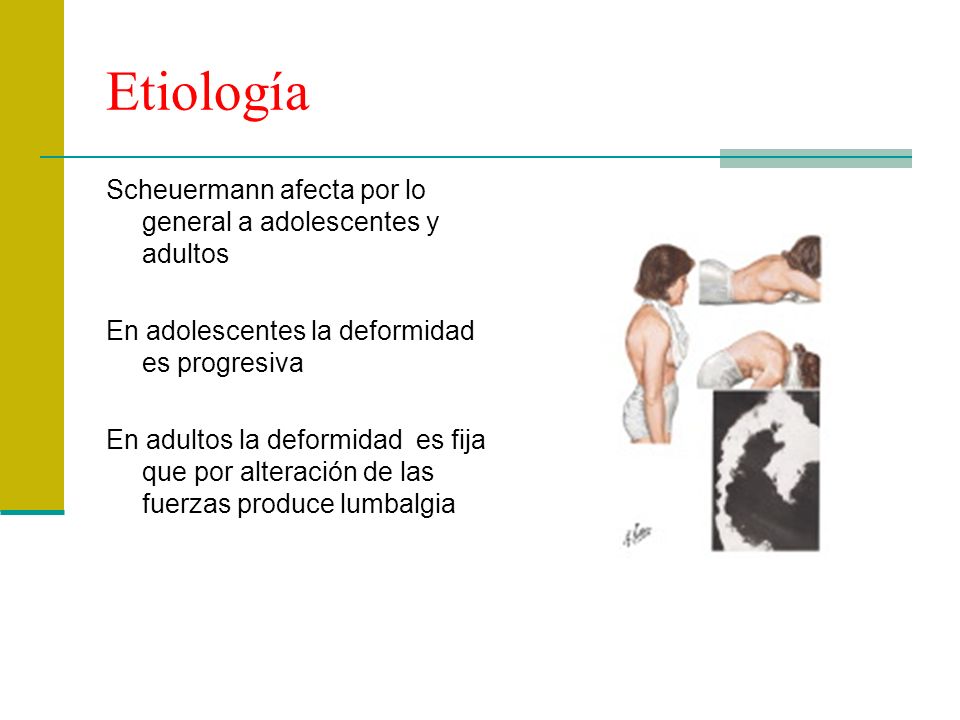 Etiología Scheuermann afecta por lo general a adolescentes y adultos