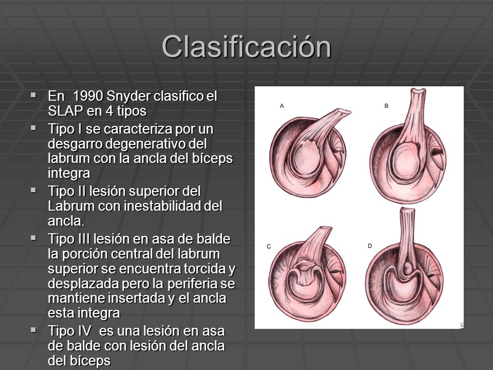 Clasificación En 1990 Snyder clasifico el SLAP en 4 tipos