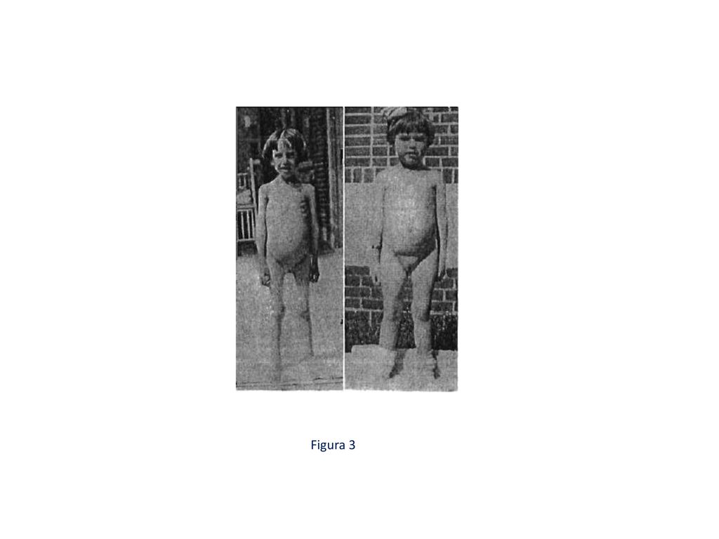 En 1924, Sydney Haas ( ) informó del éxito obtenido en ocho niños con una dieta instaurada a base de plátano que excluía el pan, los cereales y los azúcares y que se debía mantener indefinidamente. El autor acertó plenamente al recomendar una dieta sin gluten a pesar de que no entendió la razón de su éxito, puesto que creía que era el contenido de azúcar de la dieta lo que realmente tenía importancia. Quién sabe si el autor se basó sus recomendaciones en la experiencia descrita en Puerto Rico, allí, los habitantes de la ciudad sufren de sprue mientras que los agricultores que viven, en gran medida, gracias a los plátanos, nunca (figuras 2 y 3)9, 10.