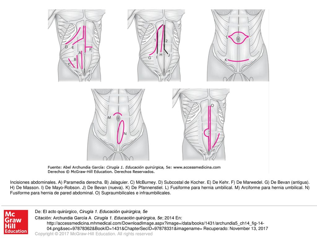 Incisiones abdominales. A) Paramedia derecha. B) Jalaguier. C) McBurney. D) Subcostal de Kocher. E) De Kehr. F) De Marwedel. G) De Bevan (antigua). H) De Masson. I) De Mayo-Robson. J) De Bevan (nueva). K) De Pfannenstiel. L) Fusiforme para hernia umbilical. M) Arciforme para hernia umbilical. N) Fusiforme para hernia de pared abdominal. O) Supraumbilicales e infraumbilicales.