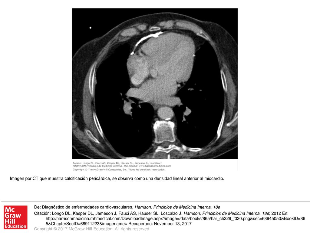 Imagen por CT que muestra calcificación pericárdica, se observa como una densidad lineal anterior al miocardio.