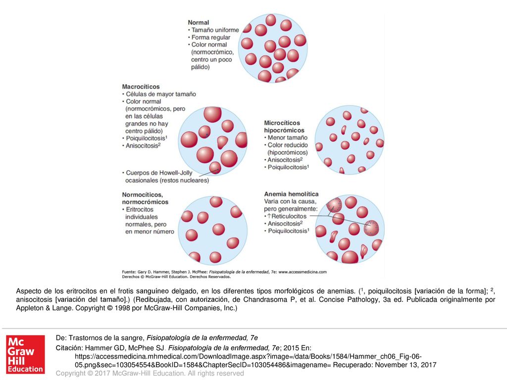 Aspecto de los eritrocitos en el frotis sanguíneo delgado, en los diferentes tipos morfológicos de anemias. (1, poiquilocitosis [variación de la forma]; 2, anisocitosis [variación del tamaño].) (Redibujada, con autorización, de Chandrasoma P, et al. Concise Pathology, 3a ed. Publicada originalmente por Appleton & Lange. Copyright © 1998 por McGraw-Hill Companies, Inc.)