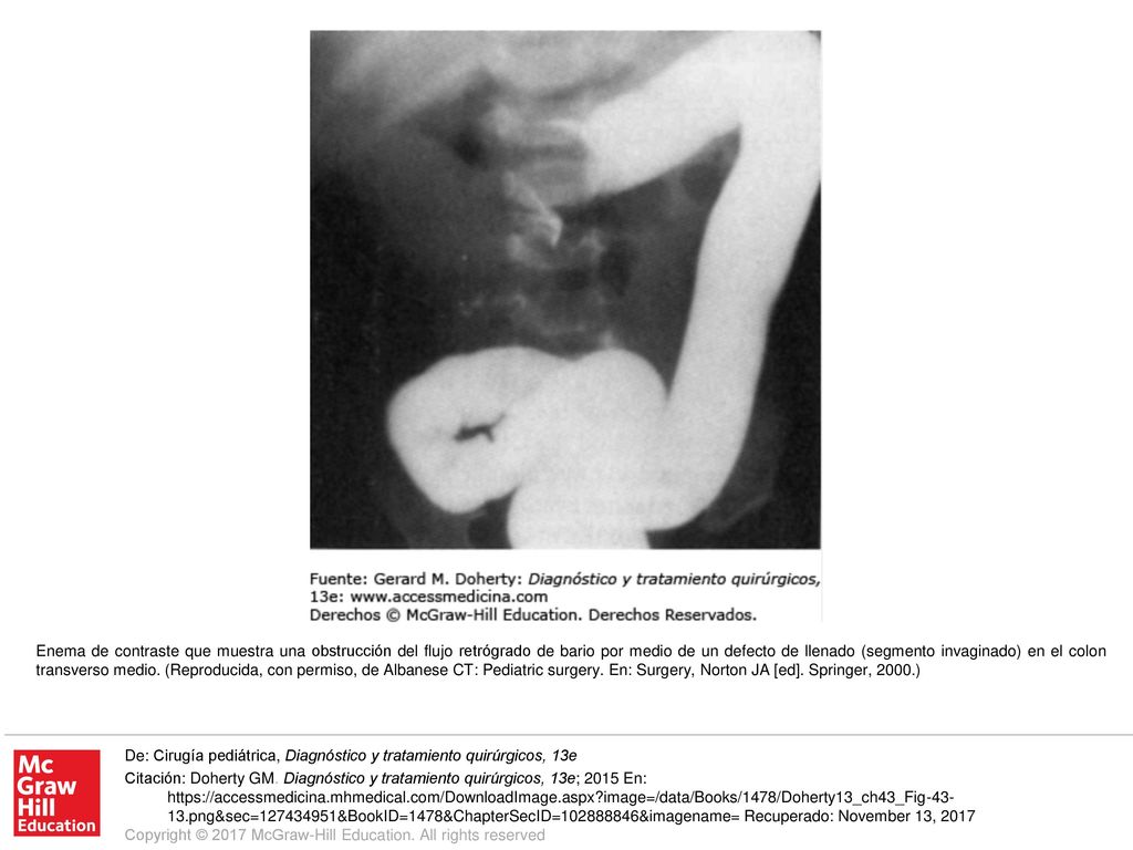 Enema de contraste que muestra una obstrucción del flujo retrógrado de bario por medio de un defecto de llenado (segmento invaginado) en el colon transverso medio. (Reproducida, con permiso, de Albanese CT: Pediatric surgery. En: Surgery, Norton JA [ed]. Springer, 2000.)