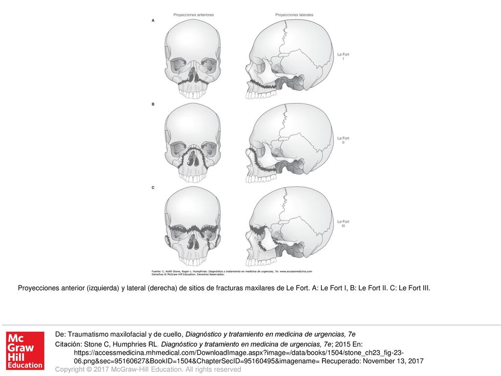 Proyecciones anterior (izquierda) y lateral (derecha) de sitios de fracturas maxilares de Le Fort. A: Le Fort I, B: Le Fort II. C: Le Fort III.