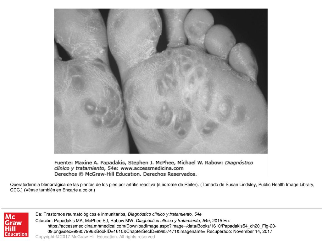 Queratodermia blenorrágica de las plantas de los pies por artritis reactiva (síndrome de Reiter). (Tomado de Susan Lindsley, Public Health Image Library, CDC.) (Véase también en Encarte a color.)