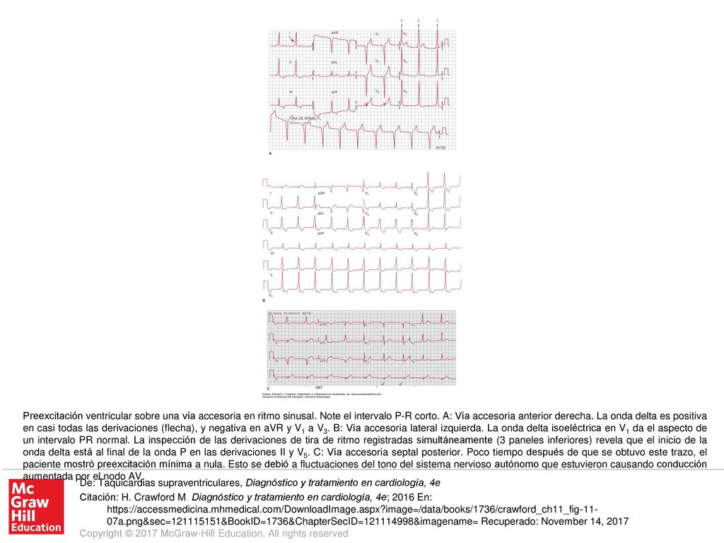 Preexcitación ventricular sobre una vía accesoria en ritmo sinusal