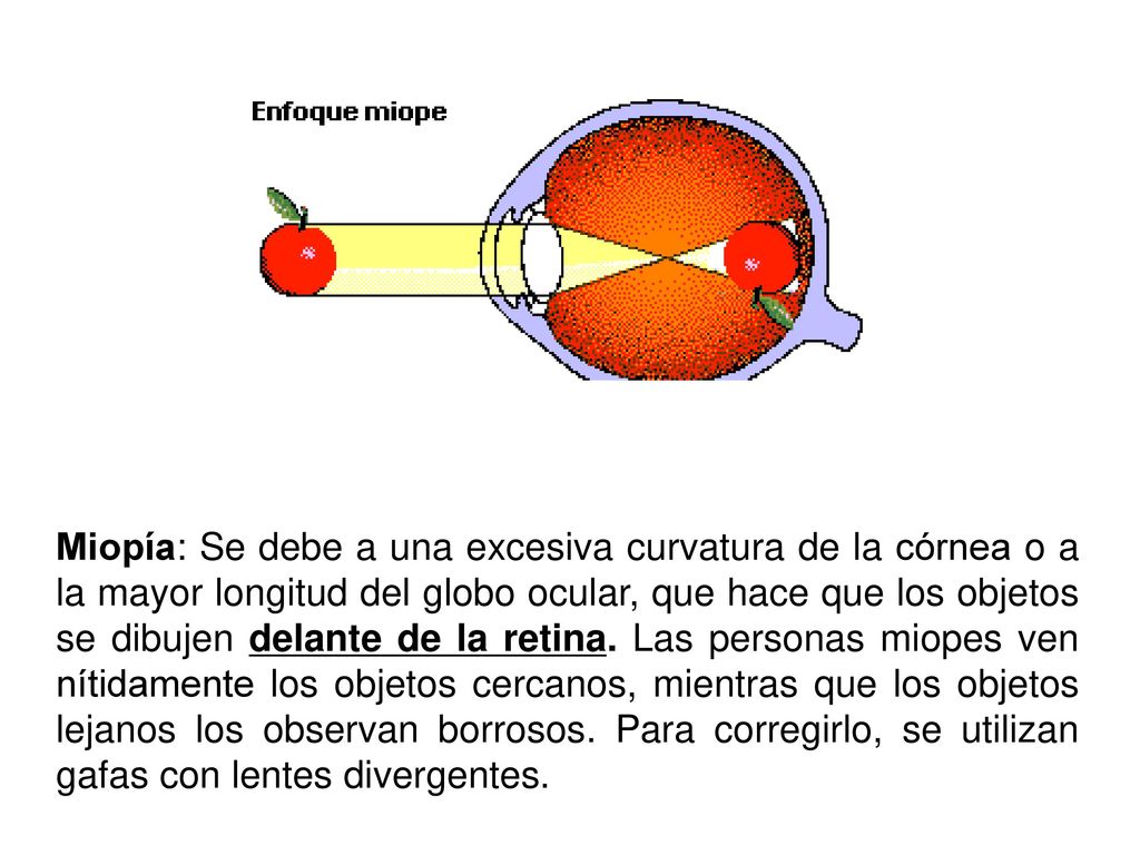 Miopía: Se debe a una excesiva curvatura de la córnea o a la mayor longitud del globo ocular, que hace que los objetos se dibujen delante de la retina.