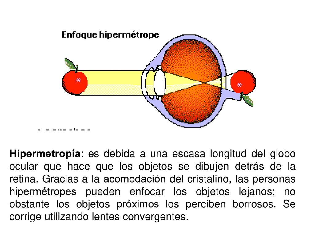 Hipermetropía: es debida a una escasa longitud del globo ocular que hace que los objetos se dibujen detrás de la retina.