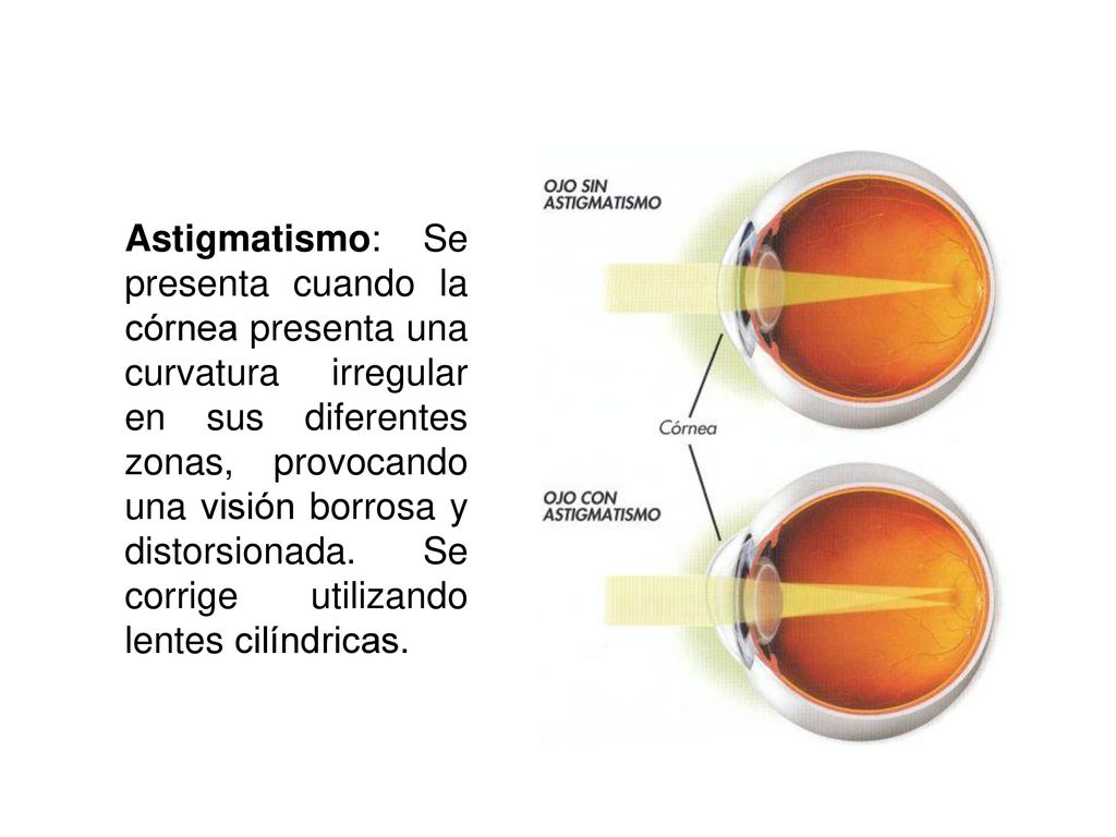 Astigmatismo: Se presenta cuando la córnea presenta una curvatura irregular en sus diferentes zonas, provocando una visión borrosa y distorsionada.