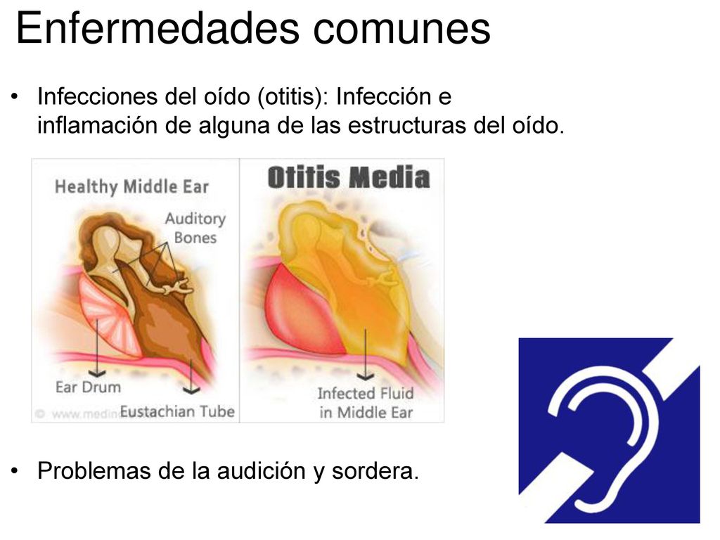 Enfermedades comunes Infecciones del oído (otitis): Infección e inflamación de alguna de las estructuras del oído.