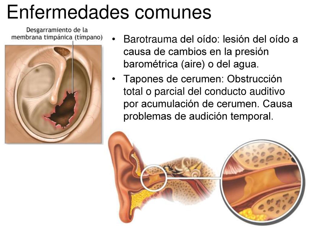Enfermedades comunes Barotrauma del oído: lesión del oído a causa de cambios en la presión barométrica (aire) o del agua.