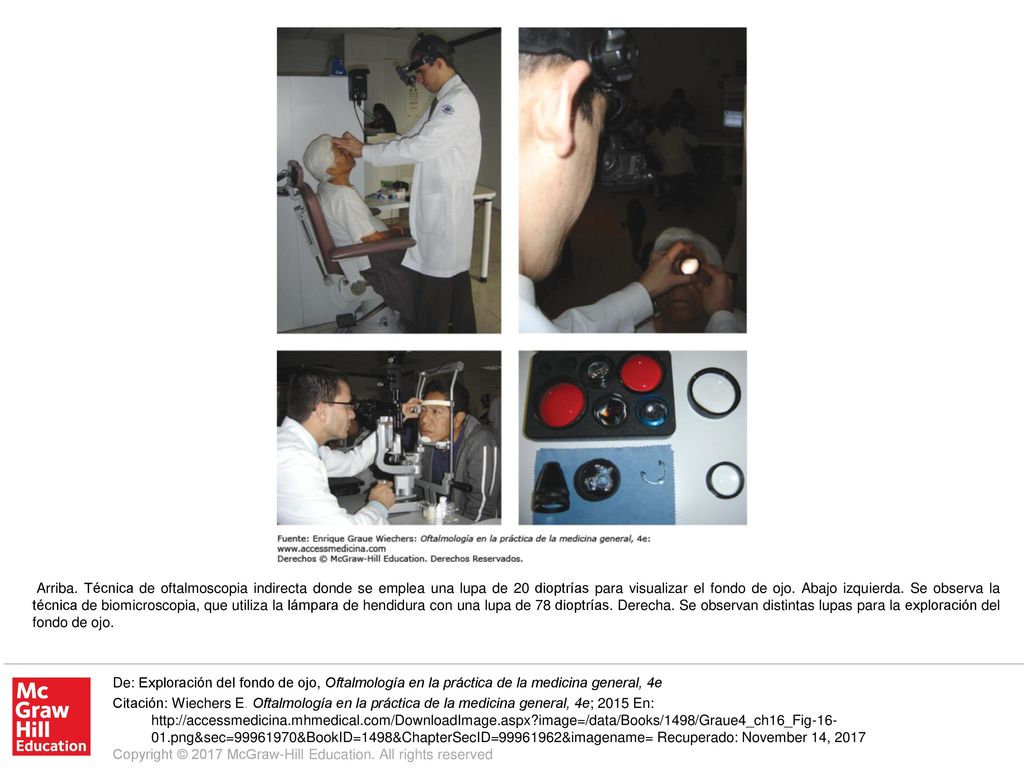 Arriba. Técnica de oftalmoscopia indirecta donde se emplea una lupa de 20 dioptrías para visualizar el fondo de ojo. Abajo izquierda. Se observa la técnica de biomicroscopia, que utiliza la lámpara de hendidura con una lupa de 78 dioptrías. Derecha. Se observan distintas lupas para la exploración del fondo de ojo.