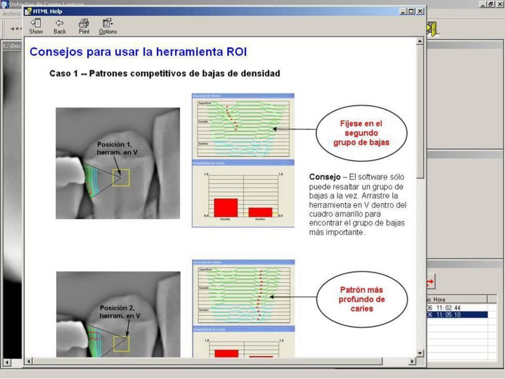 Esta tabla muestra ejemplos de la mejor manera de utilizar la anulación manual de la herramienta ROI. Existen dos casos que se presentan con frecuencia. Uno es al completar los patrones de baja de densidad en la misma superficie dental. Como el programa solo puede analizar un patrón a la vez, usted debe mover la herramienta-V para concentrarse en cualquier otro patrón que observe en la superficie. Después, debe determinar cuál es el más importante para su diagnóstico.